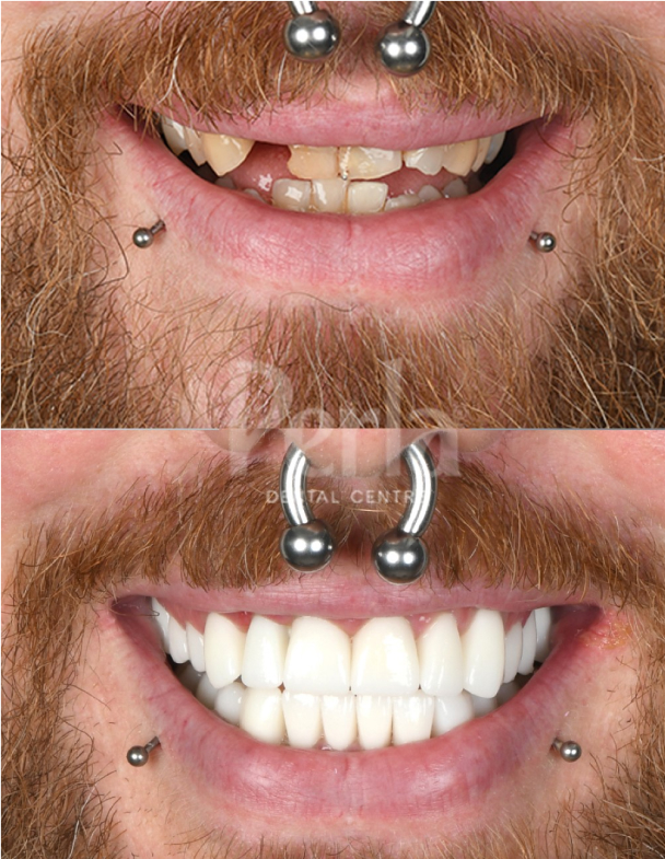 dental crowns