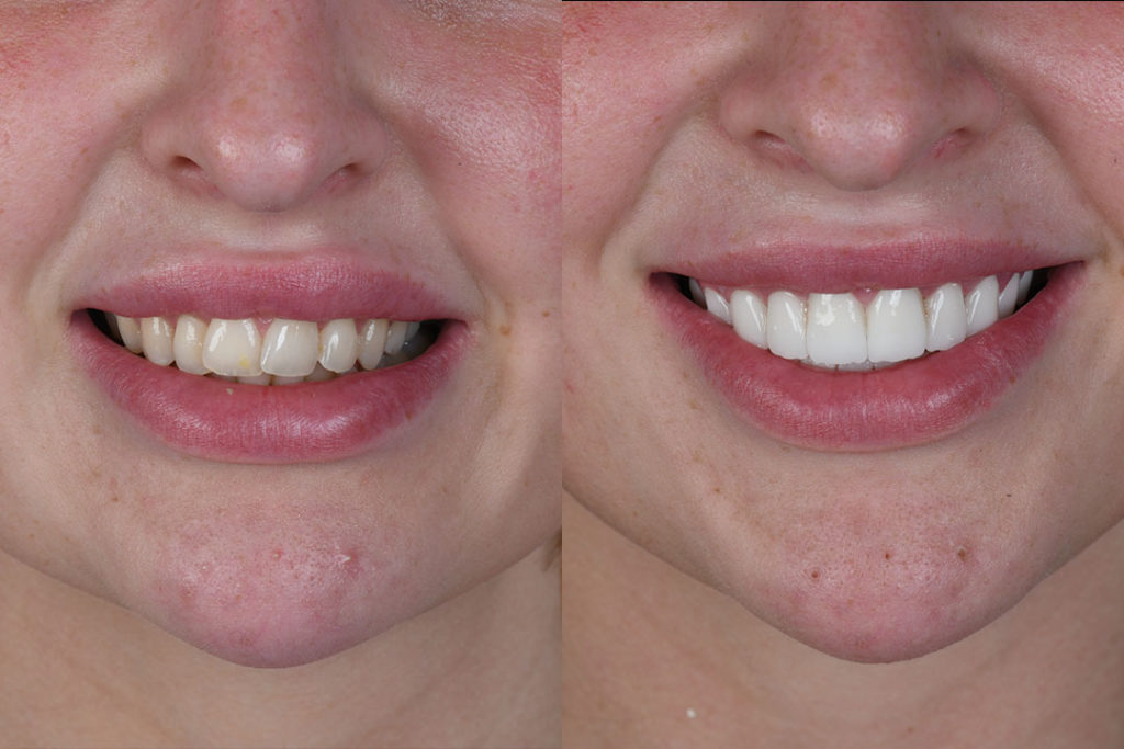 teeth whitening