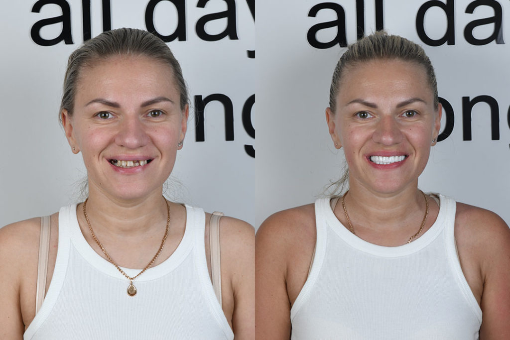 missing tooth treatment