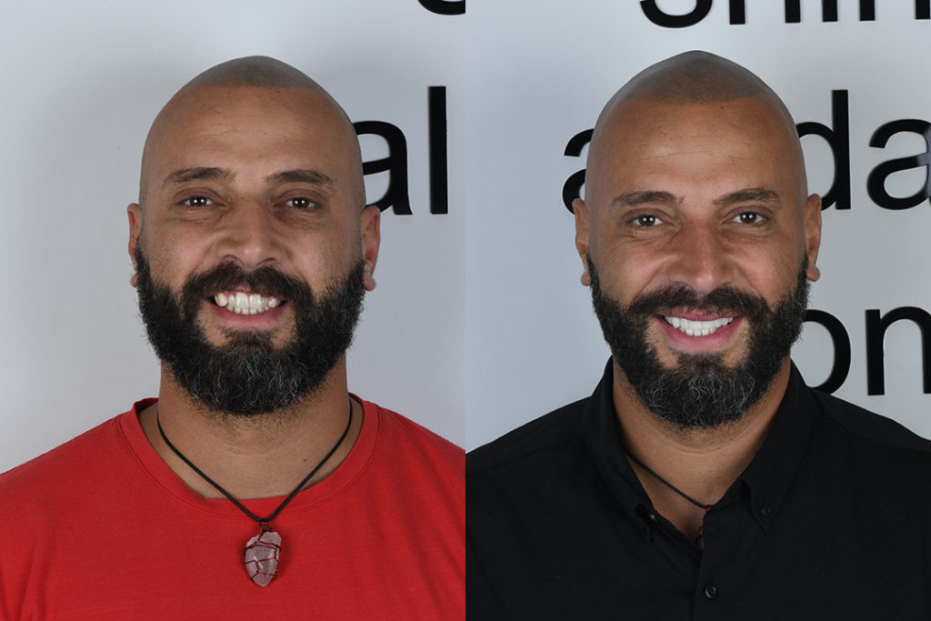full mouth implants